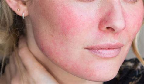 How To Treat Rosacea A Safe Approach Advanced Dermatology Treatment