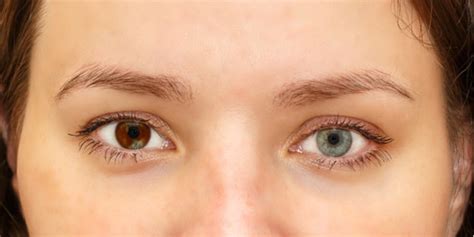 Iris Heterochromia Boston Eye Blink