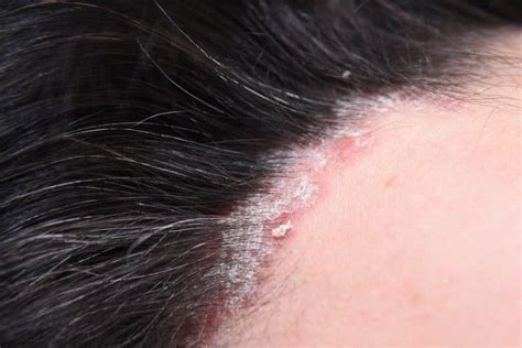 Scalp Psoriasis Treatment What Works Riverchase Dermatology