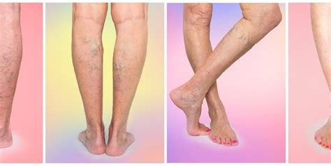 Stages Of Vein Disease When To Act Hamilton Vascular