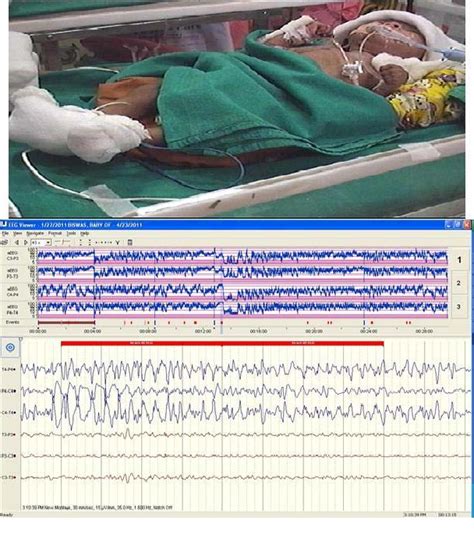 Figure 2 From Summarization Of Neonatal Video Eeg For Seizure And