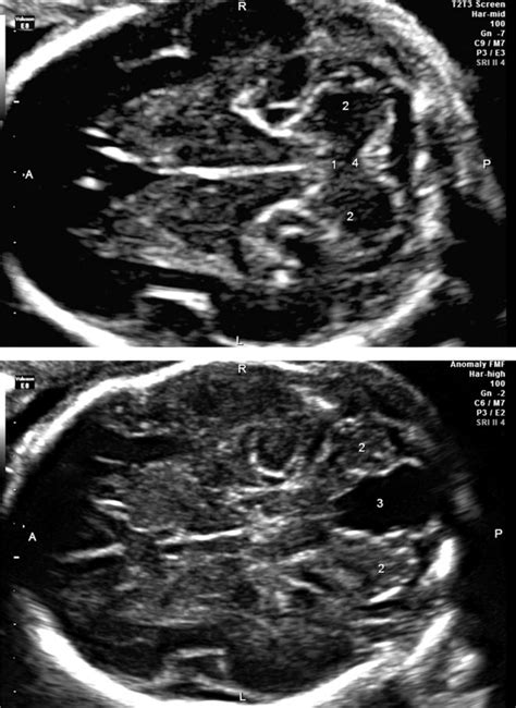 Two Dimensional Fetal Brain Ultrasound Images At 23 Weeks Gestation