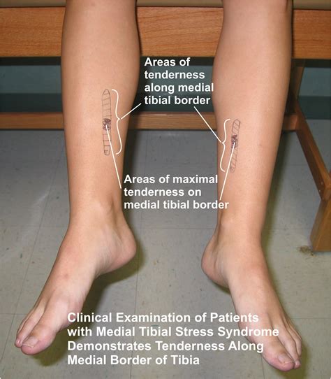 Medial Tibial Stress Syndrome Kevin A Kirby Dpm