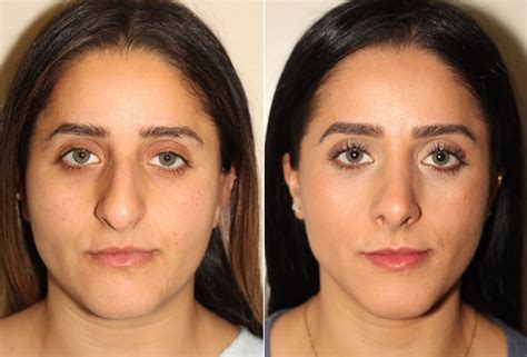 The Importance Of Skin Thickness In Rhinoplasty Dr Denton