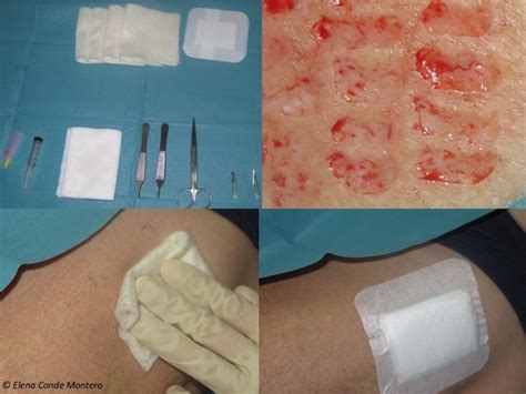 Which Dressing Should I Choose To Cover The Skin Graft Donor Site