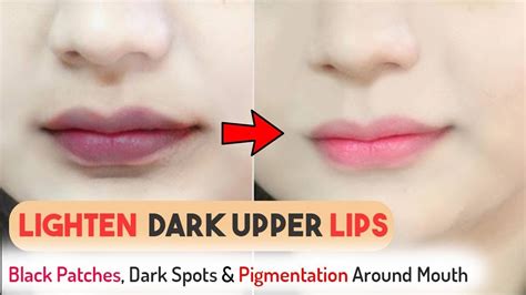 How To Lighten Dark Upper Lips Naturally Black Patches Hyper