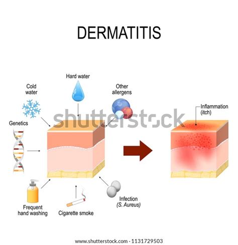 Atopic Dermatitis Atopic Eczema Healthy Skin Stock Vector Royalty Free