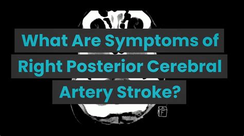 What Are Symptoms Of Right Posterior Cerebral Artery Stroke YouTube