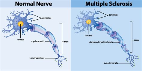 Multiple sklerose (ms) ist eine entzündliche erkrankung des zentralen nervensystems. MOOCI. Multiple Sklerose - Erkrankung des Nervensystems!