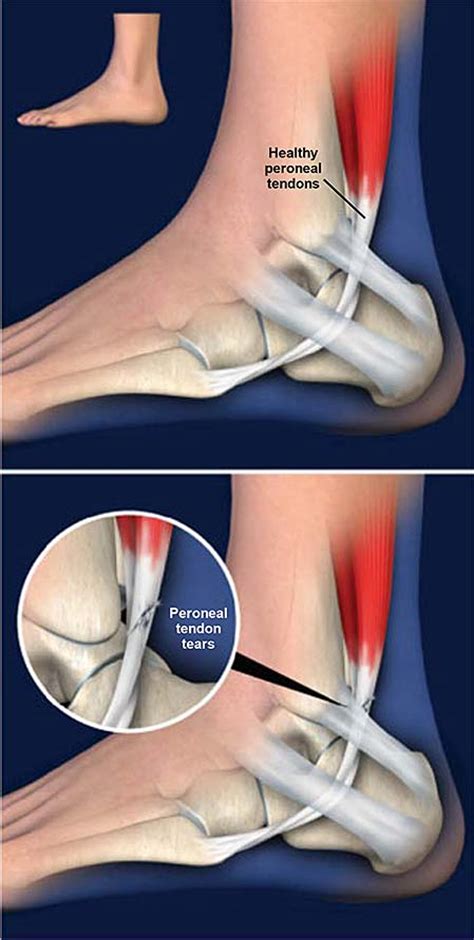 Peroneal Tendon Tears Central Coast Orthopedic Medical Group