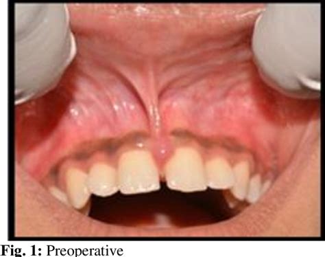 Figure 1 From Maxillary Labial Frenectomy By Using Conventional Technique And Laser Report Of