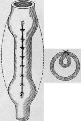 Complete Prolapse Part 3