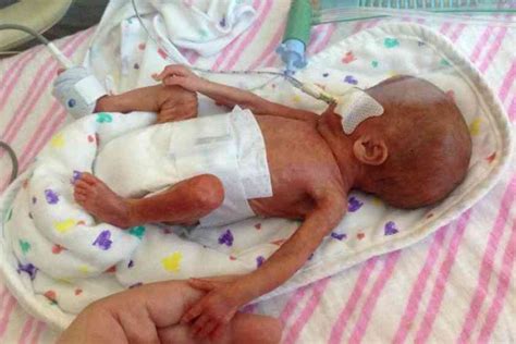 Top 10 Smallest Newborn Babies In The World Top Tens