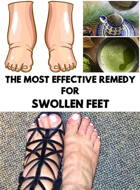 Swollen Feet The Most Effective Remedy For Swollen Feet Foot Remedies Swollen Feet Remedy