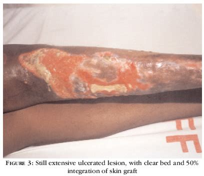 It was first identified by the spanish cardiologist fernando martorell in 1945, who referred to the ulcers as 'hypertensive ischaemic ulcers'. Martorell's Ulcer : Leg Ulcers And Lymphedema Springerlink ...