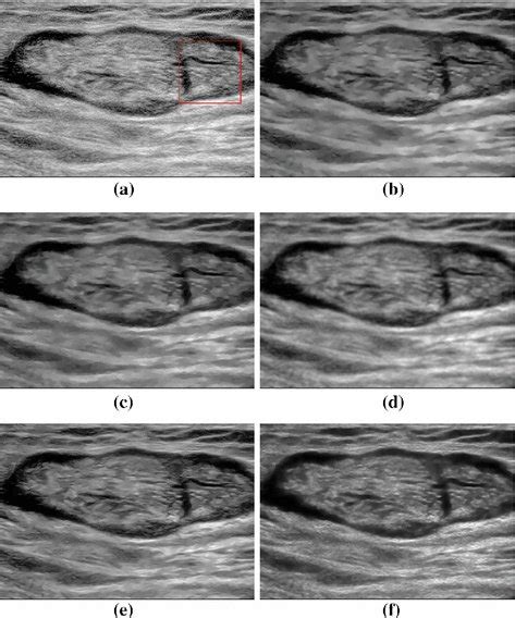 The Despeckled Results On A Real Ultrasound Lymph Node Image A The