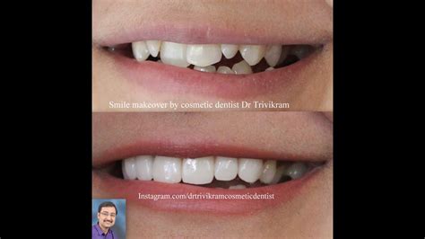 Everyone, no matter their age, wants to have teeth that are straight and beautiful. How to correct crooked teeth without braces. View before ...
