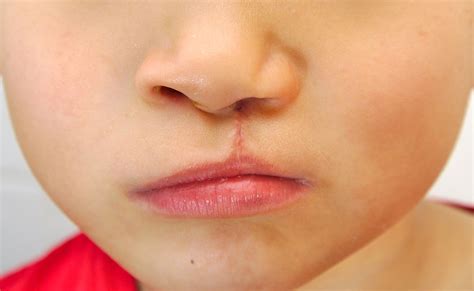 Every effort is made to keep scars to a minimum and to place scars so that they are easily concealed. Cleft Lip and Cleft Palate - ENT Health