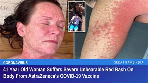 41 Year Old Woman Suffers Unbearable Burning Red Rash On Body From
