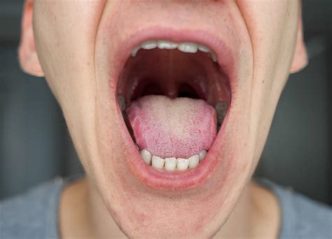 Healthy Tonsils