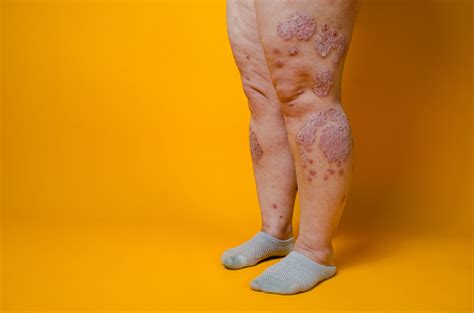 Malattia Dermatologica Della Pelle Psoriasi Eczema Dermatite Allergie