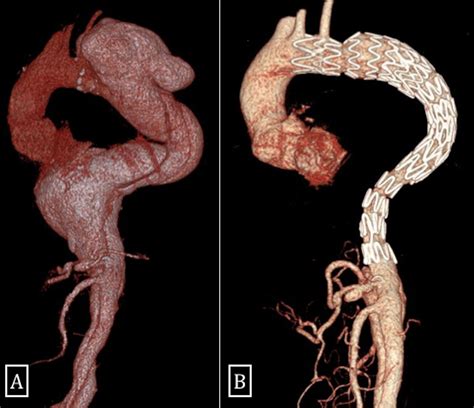 Current Management Of Type B Aortic Dissection Ncbi Nih