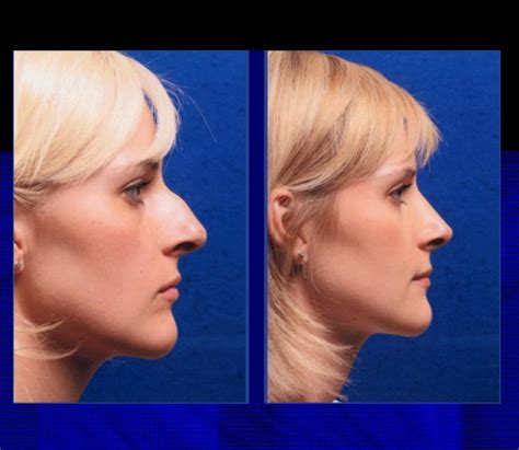 The Nose Clinic Before And After Nose Surgery Photos 9