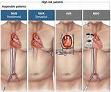 Aortic Stenosis Treatment Options Images