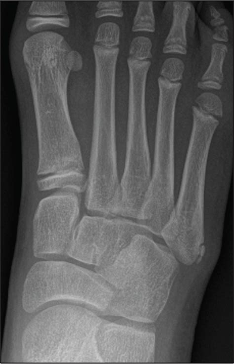 Pediatric Ankle Sprains and Their Imitators