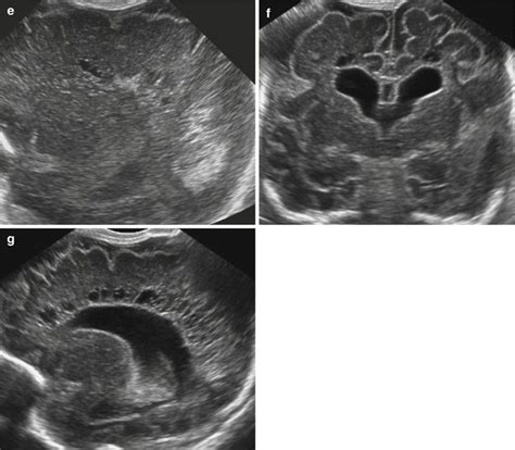 Cranial Ultrasound In Cerebral Palsy Springerlink
