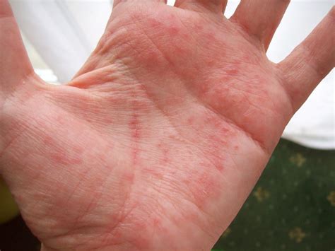 Treatment For Blisters On Hands