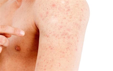 Causes Of Heat Rash Heat Hives Symptoms Treatment And Prevention