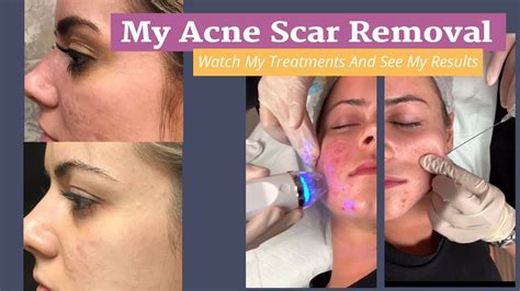 My Acne Scar Removal Journey Rf Microneedling With Prp Treatments And