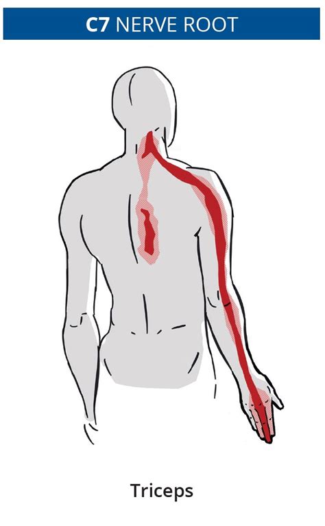 Pin On Cervical Radiculopathy