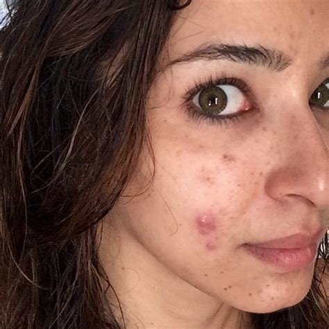 Why This Dermatologist Wants To Fight Adult Cystic Acne Stigma Allure