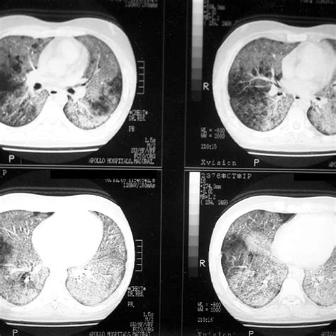 Ct Chest Showing Bilateral Ground Glass “crazy Paving” Pattern