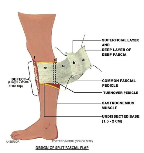 Plan Of Split Fascial Flap A And B Split Deep And Superficial Layers