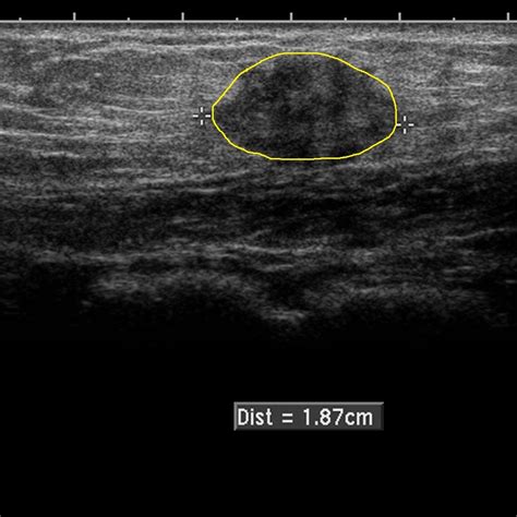 Abdominal Mass Ultrasound
