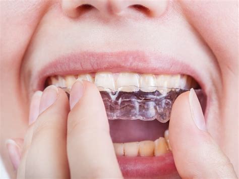Top 5 Side Effects Of Teeth Grinding Sdg Dental Clinic