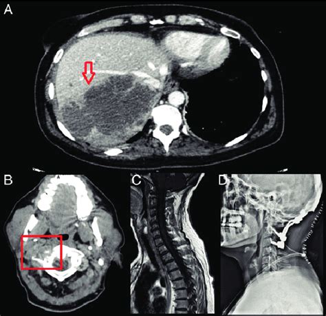 A Abdominal Computed Tomography Ct Axial Section Identified A
