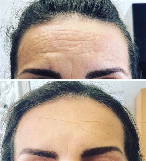 Before And After A Perfect Skin Peel On The Forehead Skin Peel Skin