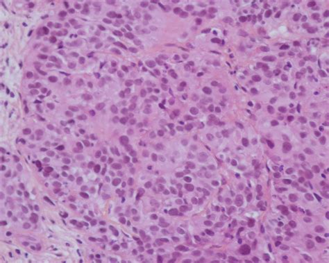 Cureus An Uncommon Case Of Renal Metastasis From Cervical Cancer
