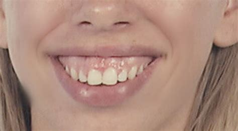 One of the most common factors is an abnormal eruption of the teeth. Gummy smile | Velthuis kliniek