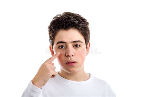 Acne Caucasian Boy Pointing With Right Index To His Eye Stock Image
