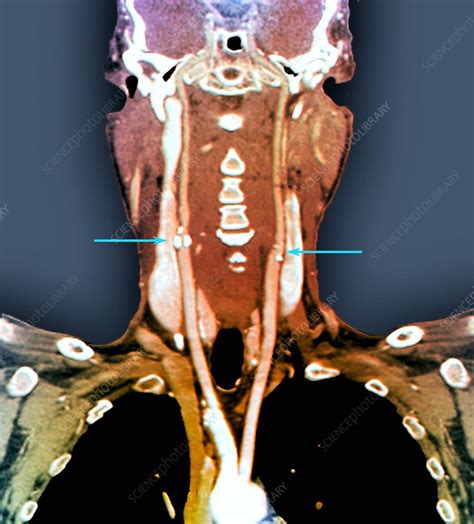 Narrowed Carotid Arteries Ct Angiogram Stock Image C0370791