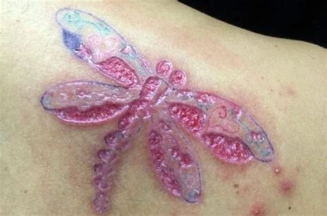 Tatuaje Mal Curado Síntomas Y Tratamiento Tatuantes