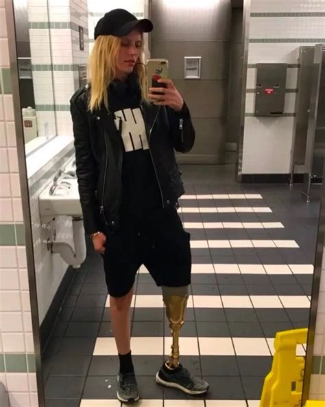 Model Whose Leg Was Amputated After Toxic Shock Syndrome From Tampon