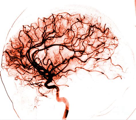 Cerebral Angiogram Photograph By Medical Body Scans Fine Art America