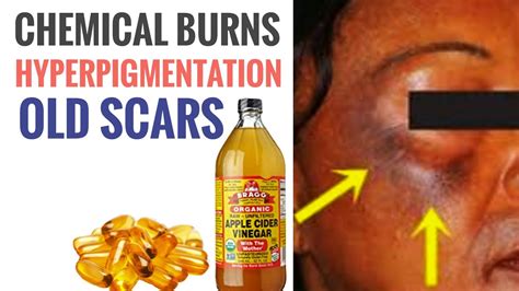 How To Treat Chemical Burn Bleaching Cream Burn Skin Mercury Burn