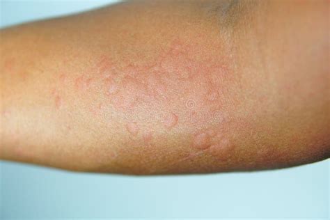 Eruzione Cutanea Intensa Di Allergia Su Pelle Sensibile Fotografia
